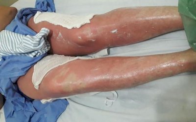 Mulher tem queimaduras de 3º grau e está em estado grave após se bronzear com chá de folha de figo