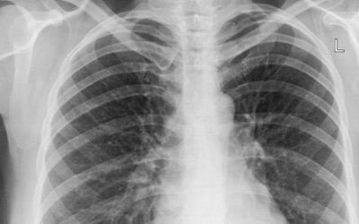 PNEUMONIA TAMBÉM PODE ATACAR NO VERÃO