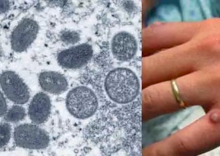 Mato Grosso do Sul tem primeiro caso suspeito da varíola dos macacos