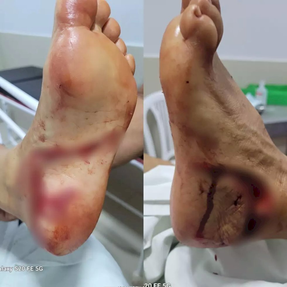 Turista tem corte profundo no pé após levar mordida de dourado no Rio Formoso